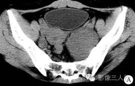 【病例】盆底孤立性纤维瘤1例CT影像表现