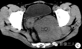 【病例】盆底孤立性纤维瘤1例CT影像表现