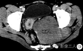 【病例】盆底孤立性纤维瘤1例CT影像表现