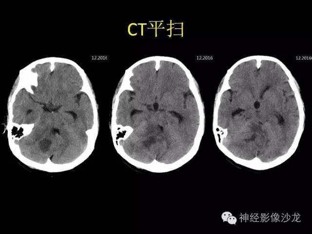 【病例】间变型血管周细胞瘤1例MR影像表现