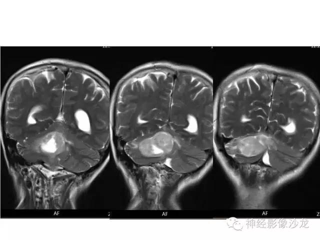 【病例】间变型血管周细胞瘤1例MR影像表现