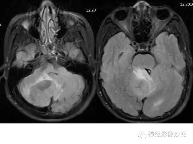 【病例】间变型血管周细胞瘤1例MR影像表现