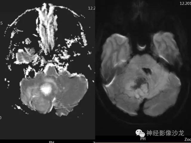 【病例】间变型血管周细胞瘤1例MR影像表现