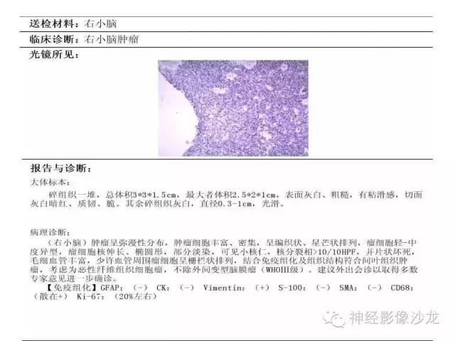 【病例】间变型血管周细胞瘤1例MR影像表现