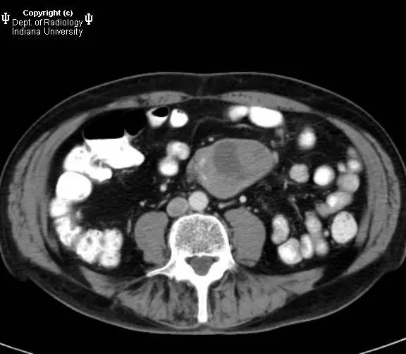 【病例】肠系膜淋巴瘤伴肝转移1例CT影像表现 【病例】肠系膜淋巴瘤伴肝转移1例CT影像表现