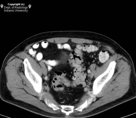 【病例】肠系膜淋巴瘤伴肝转移1例CT影像表现 【病例】肠系膜淋巴瘤伴肝转移1例CT影像表现
