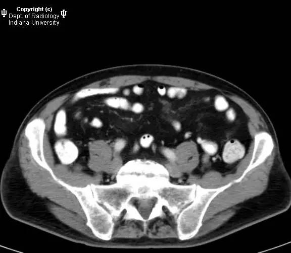 【病例】肠系膜淋巴瘤伴肝转移1例CT影像表现 【病例】肠系膜淋巴瘤伴肝转移1例CT影像表现