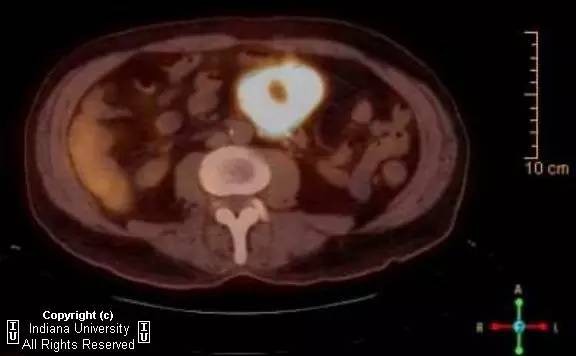 【病例】肠系膜淋巴瘤伴肝转移1例CT影像表现 【病例】肠系膜淋巴瘤伴肝转移1例CT影像表现