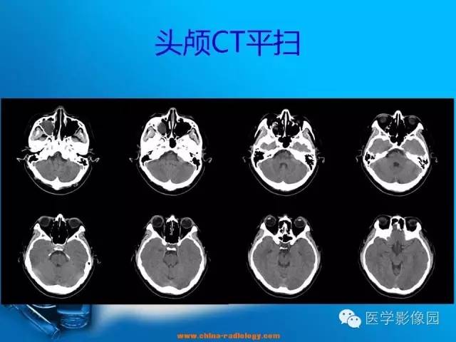 【病例】左侧桥小脑角区淋巴瘤1例MR影像表现 【病例】左侧桥小脑角区淋巴瘤1例MR影像表现