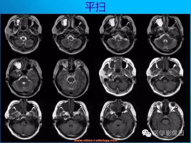 【病例】左侧桥小脑角区淋巴瘤1例MR影像表现 【病例】左侧桥小脑角区淋巴瘤1例MR影像表现