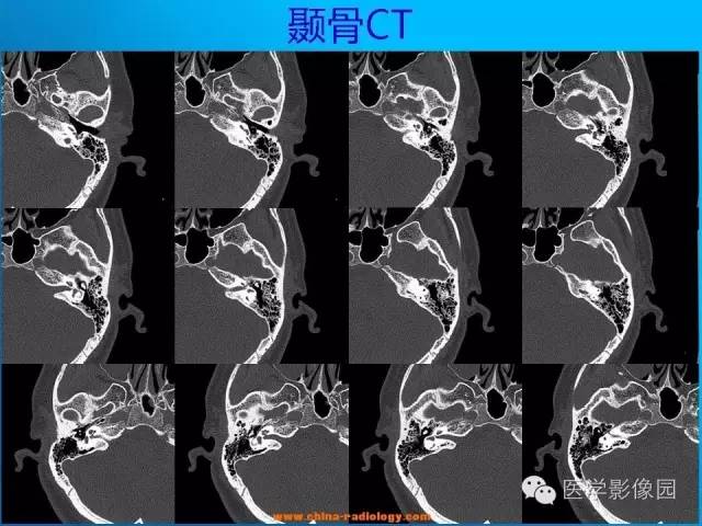 【病例】左侧桥小脑角区淋巴瘤1例MR影像表现 【病例】左侧桥小脑角区淋巴瘤1例MR影像表现