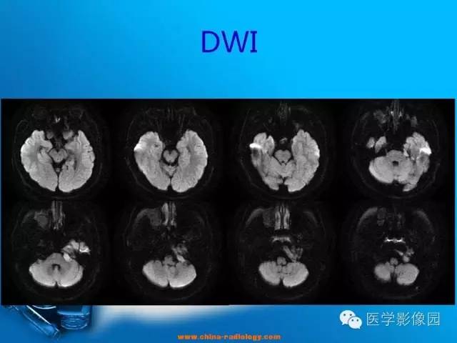 【病例】左侧桥小脑角区淋巴瘤1例MR影像表现 【病例】左侧桥小脑角区淋巴瘤1例MR影像表现