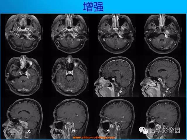 【病例】左侧桥小脑角区淋巴瘤1例MR影像表现 【病例】左侧桥小脑角区淋巴瘤1例MR影像表现