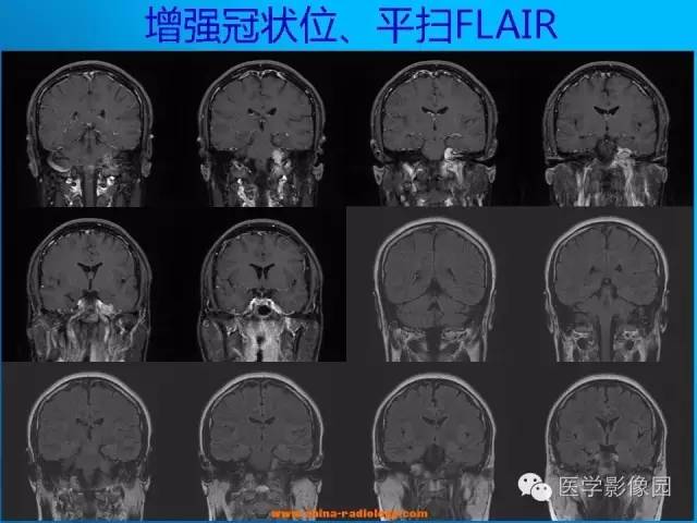 【病例】左侧桥小脑角区淋巴瘤1例MR影像表现 【病例】左侧桥小脑角区淋巴瘤1例MR影像表现