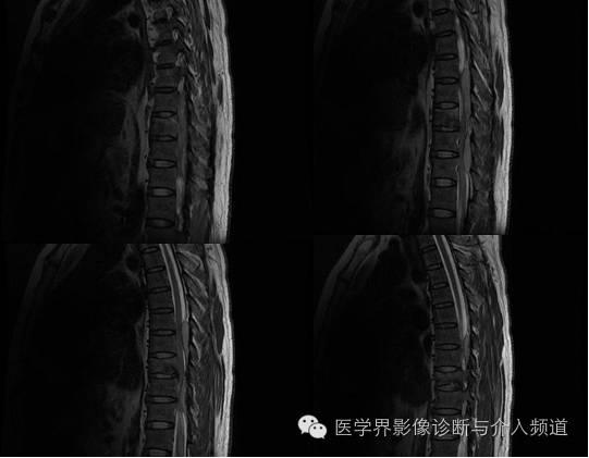 【病例】椎管内硬膜外淋巴瘤1例MR影像表现