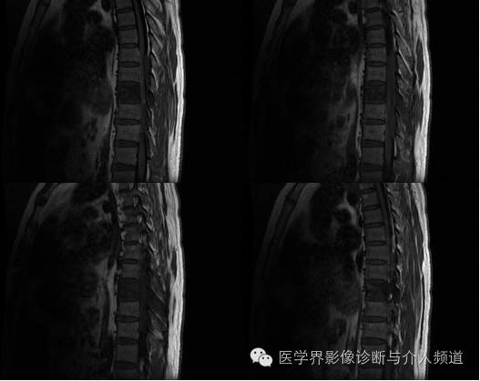【病例】椎管内硬膜外淋巴瘤1例MR影像表现 【病例】椎管内硬膜外淋巴瘤1例MR影像表现