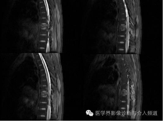【病例】椎管内硬膜外淋巴瘤1例MR影像表现 【病例】椎管内硬膜外淋巴瘤1例MR影像表现