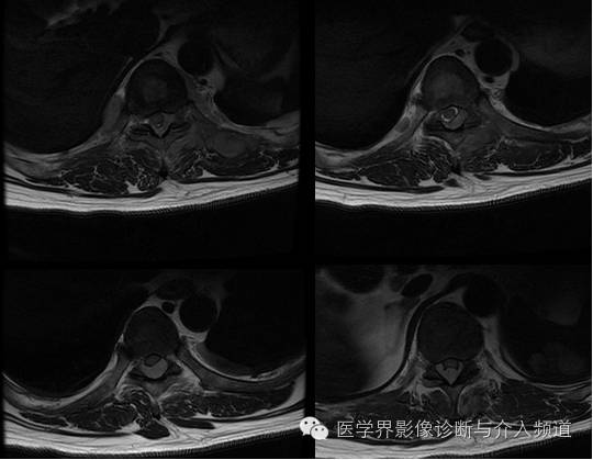 【病例】椎管内硬膜外淋巴瘤1例MR影像表现 【病例】椎管内硬膜外淋巴瘤1例MR影像表现