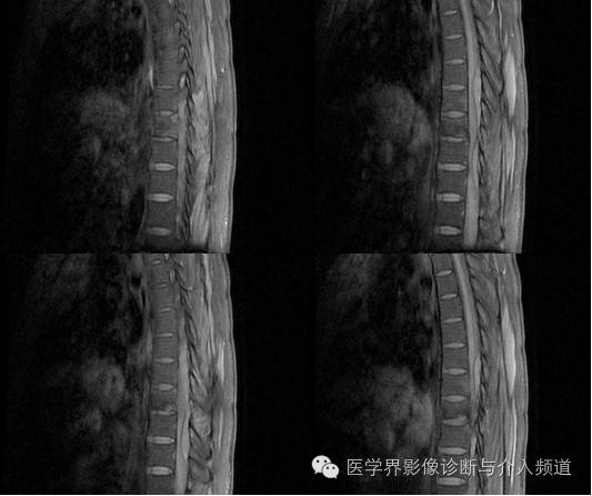 【病例】椎管内硬膜外淋巴瘤1例MR影像表现 【病例】椎管内硬膜外淋巴瘤1例MR影像表现