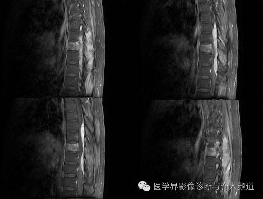 【病例】椎管内硬膜外淋巴瘤1例MR影像表现 【病例】椎管内硬膜外淋巴瘤1例MR影像表现