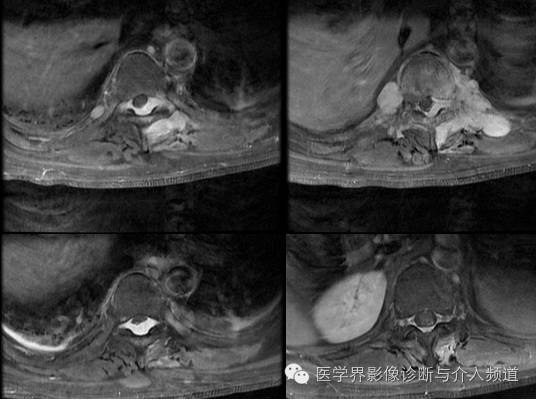【病例】椎管内硬膜外淋巴瘤1例MR影像表现 【病例】椎管内硬膜外淋巴瘤1例MR影像表现