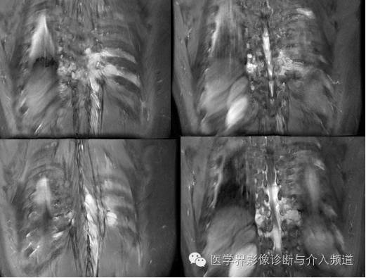 【病例】椎管内硬膜外淋巴瘤1例MR影像表现 【病例】椎管内硬膜外淋巴瘤1例MR影像表现