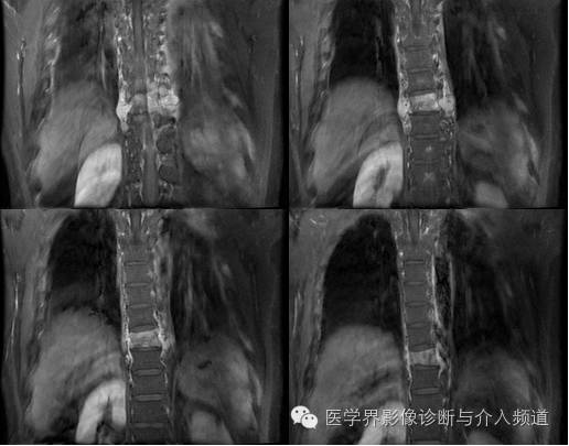 【病例】椎管内硬膜外淋巴瘤1例MR影像表现 【病例】椎管内硬膜外淋巴瘤1例MR影像表现