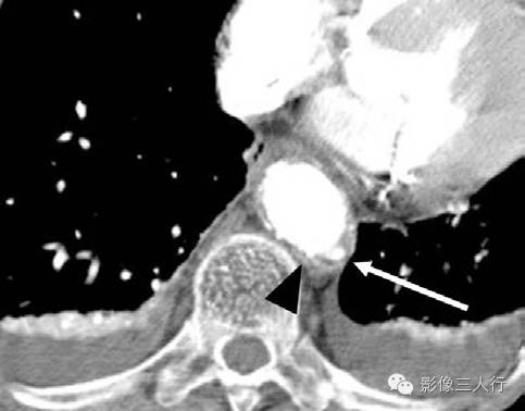 穿透性主动脉粥样硬化性溃疡