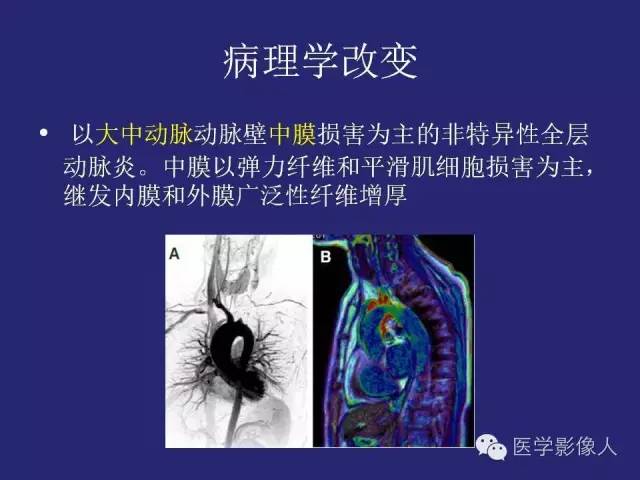 【PPT】大动脉炎分型及CT诊断