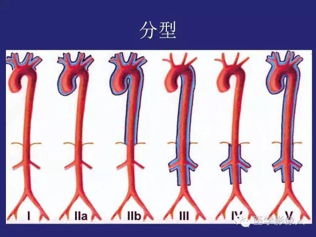 【PPT】大动脉炎分型及CT诊断
