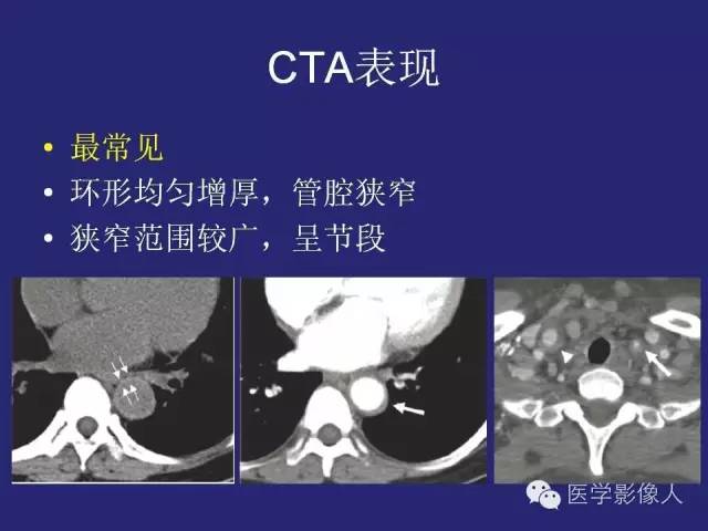【PPT】大动脉炎分型及CT诊断