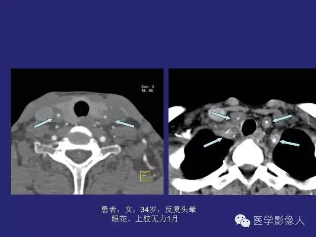 【PPT】大动脉炎分型及CT诊断