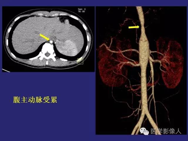 【PPT】大动脉炎分型及CT诊断