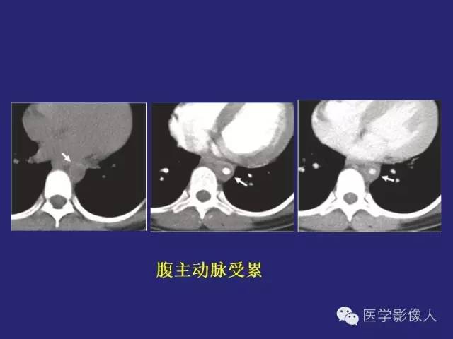 【PPT】大动脉炎分型及CT诊断