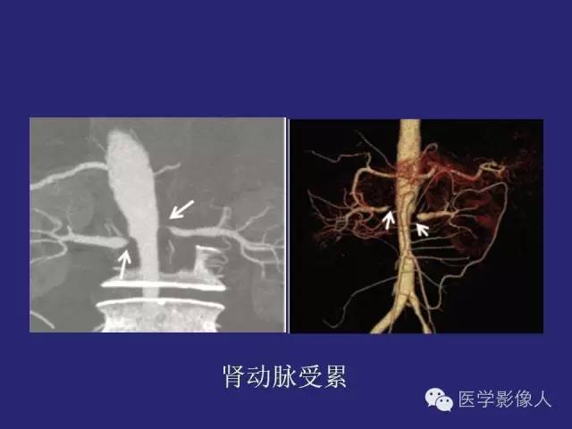 【PPT】大动脉炎分型及CT诊断