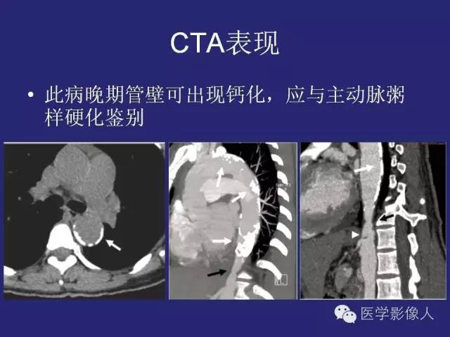 【PPT】大动脉炎分型及CT诊断