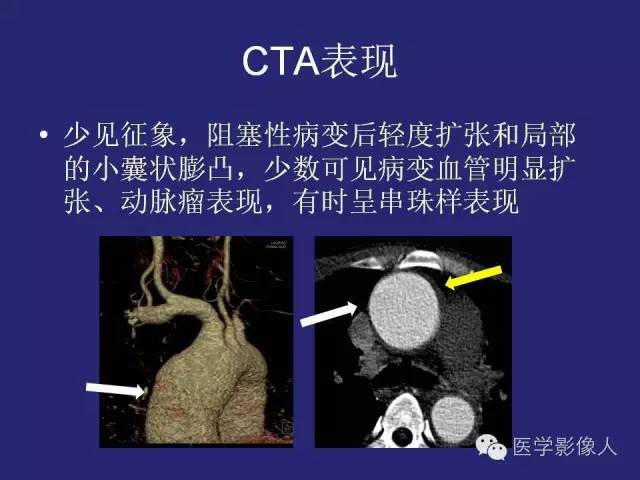 【PPT】大动脉炎分型及CT诊断