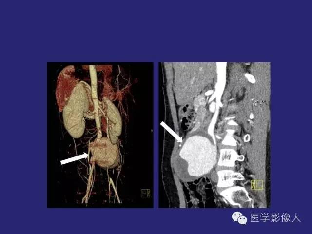 【PPT】大动脉炎分型及CT诊断