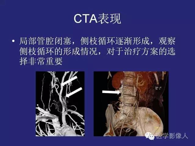 【PPT】大动脉炎分型及CT诊断