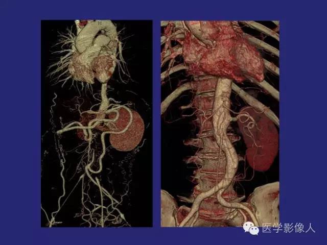 【PPT】大动脉炎分型及CT诊断