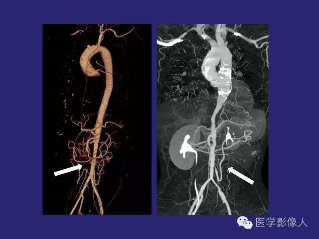 【PPT】大动脉炎分型及CT诊断
