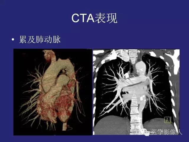 【PPT】大动脉炎分型及CT诊断