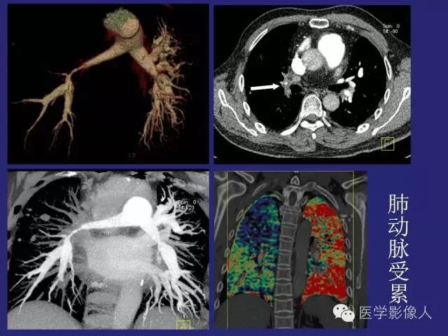 【PPT】大动脉炎分型及CT诊断