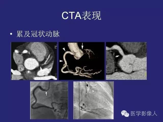【PPT】大动脉炎分型及CT诊断