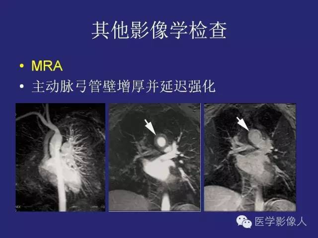 【PPT】大动脉炎分型及CT诊断