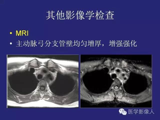 【PPT】大动脉炎分型及CT诊断