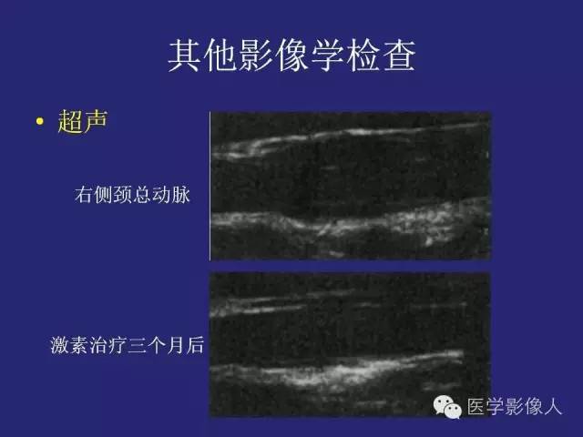 【PPT】大动脉炎分型及CT诊断