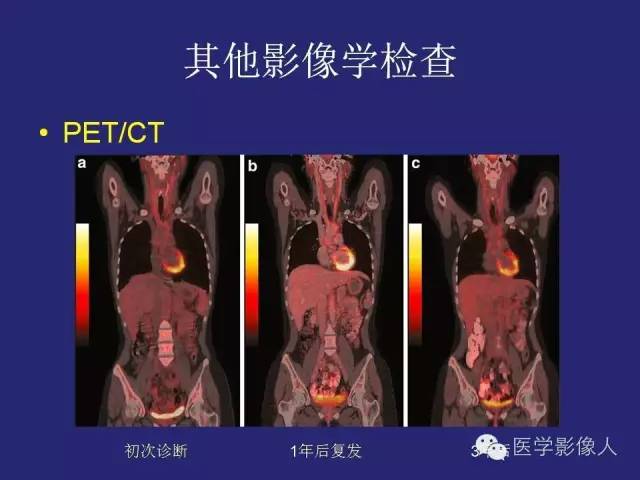 【PPT】大动脉炎分型及CT诊断