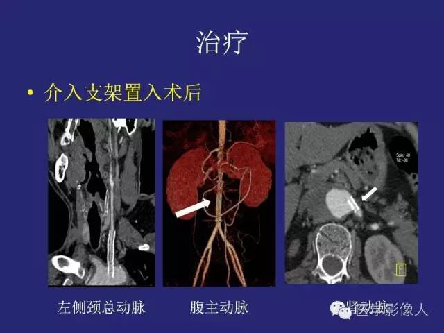 【PPT】大动脉炎分型及CT诊断