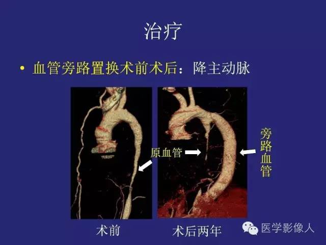 【PPT】大动脉炎分型及CT诊断